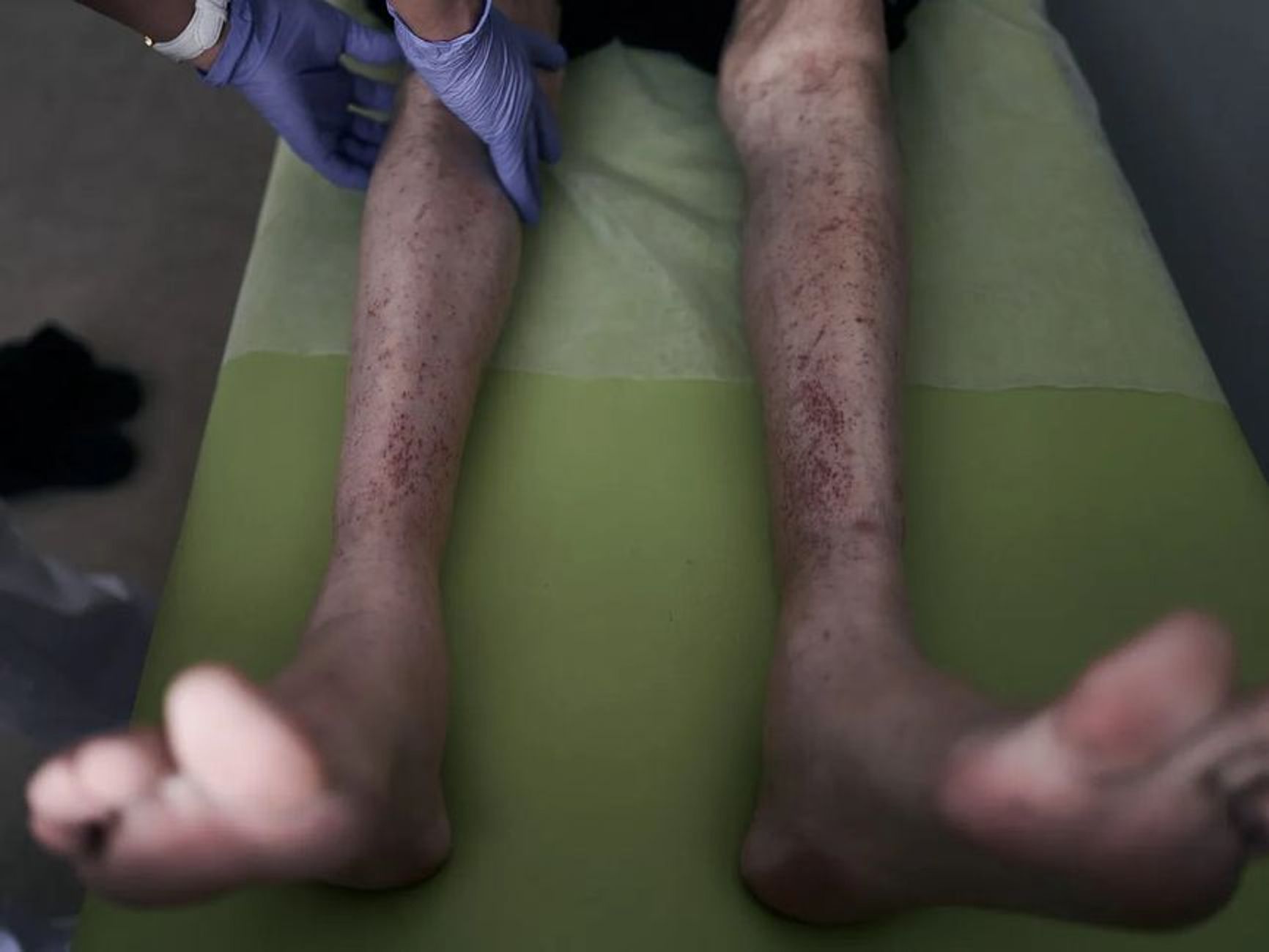 A Ukrainian soldier after Russian captivity.