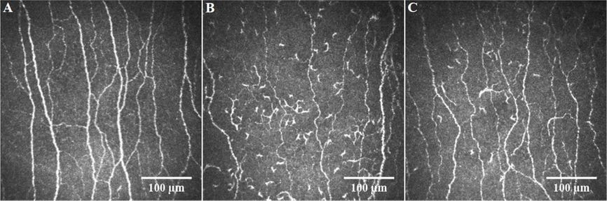 Representative corneal confocal microscopic images of the central corneal sub-basal nerve plexus in a healthy control participant (A), and in COVID-19 patients with (B) and without (C) long COVID